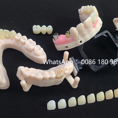 法国义齿实验室 法国假牙工厂代加工 深圳假牙工厂出口
