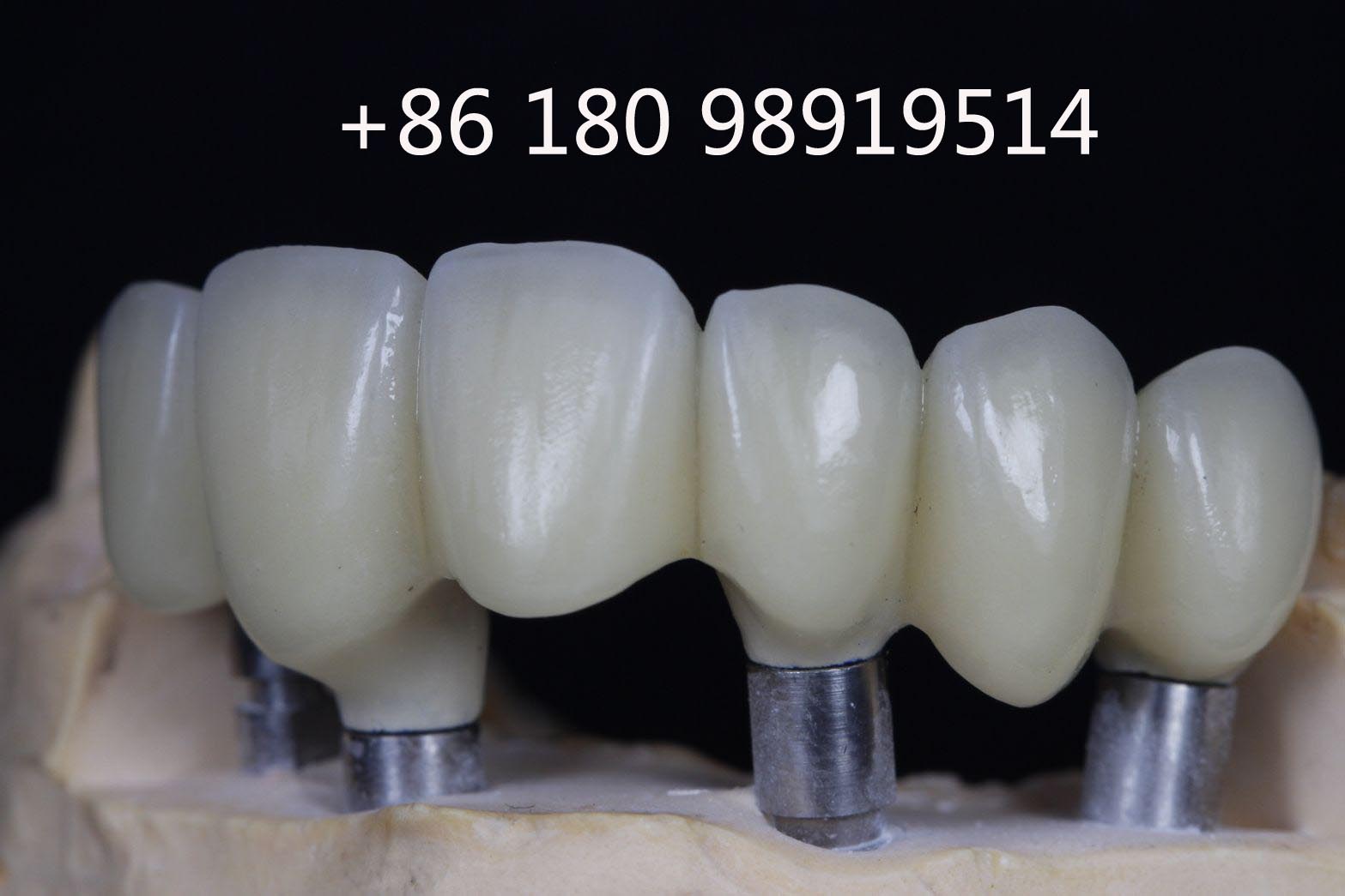 定制种植义齿加工厂提供种植义齿、活动义齿、正畸义齿制作